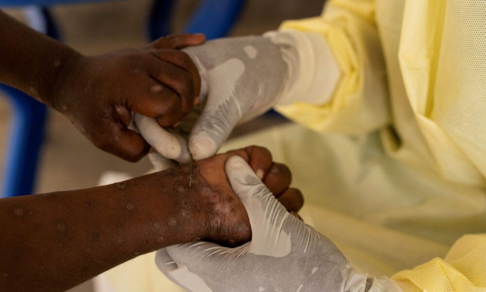 brasil-registra-88-casos-de-mpox-em-2026;-saiba-como-evitar-a-doenca
