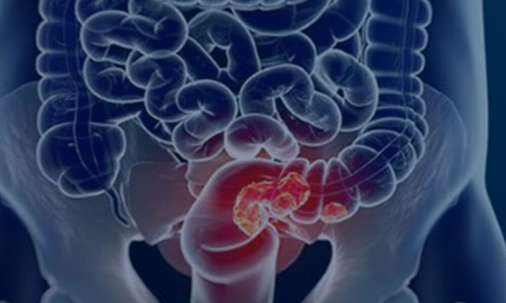 rastreamento-para-cancer-colorretal-pode-ser-implementado-no-sus