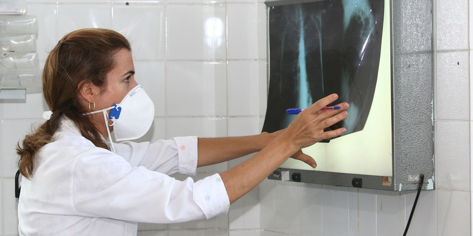 oms-recomenda-testes-de-diagnostico-rapido-para-erradicar-tuberculose
