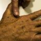 desinformacao-sobre-cancer-de-pele-afeta-diagnostico,-diz-instituicao