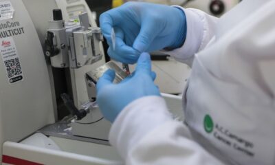 sus-inclui-nova-terapia-para-pacientes-adultos-com-leucemia-mieloide