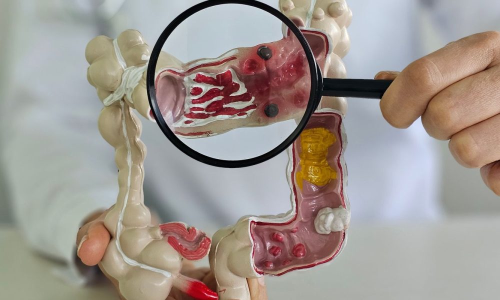 em-13-anos,-doenca-inflamatoria-intestinal-cresce-5-vezes-no-brasil