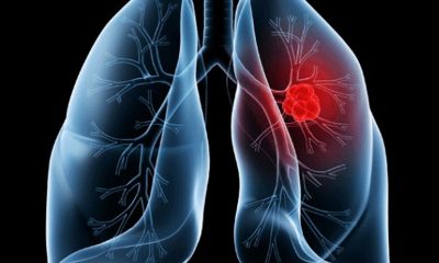 saiba-o-que-e-adenocarcinoma-pulmonar,-cancer-que-atinge-o-papa
