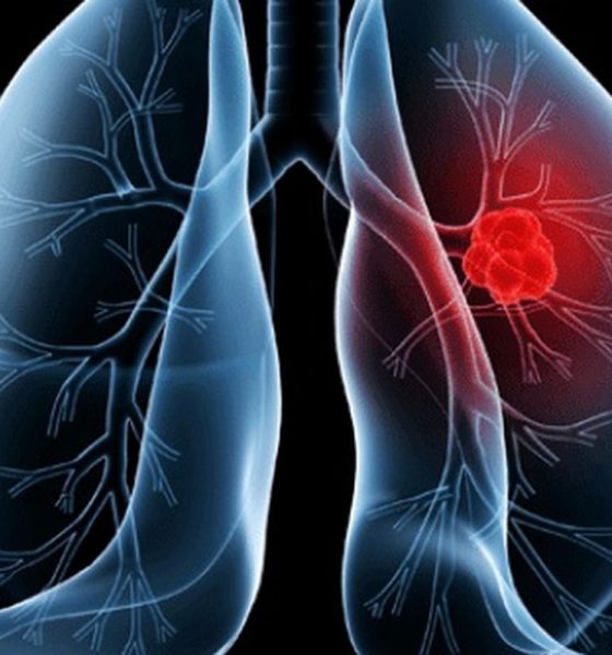 saiba-o-que-e-adenocarcinoma-pulmonar,-cancer-que-atinge-o-papa