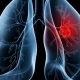saiba-o-que-e-adenocarcinoma-pulmonar,-cancer-que-atinge-o-papa