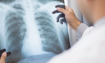 anvisa-aprova-novo-medicamento-para-cancer-de-pulmao-avancado